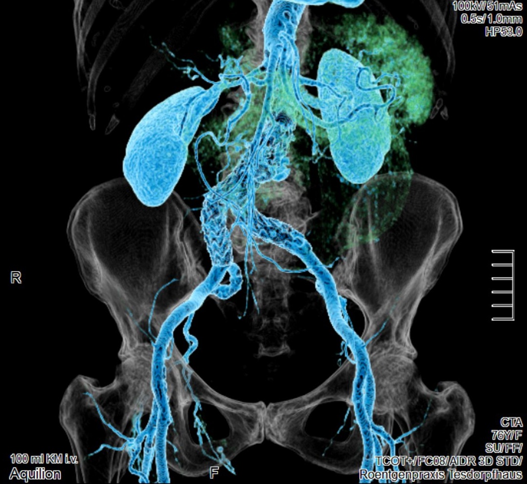 CT Bein / Gefäße | Röntgenpraxis im Tesdorpfhaus