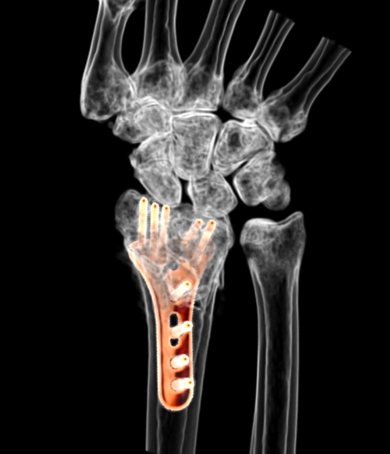 CT Handgelenk / LWS | Röntgenpraxis im Tesdorpfhaus