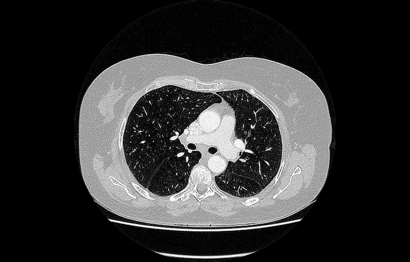 CT Lunge | Röntgenpraxis im Tesdorpfhaus