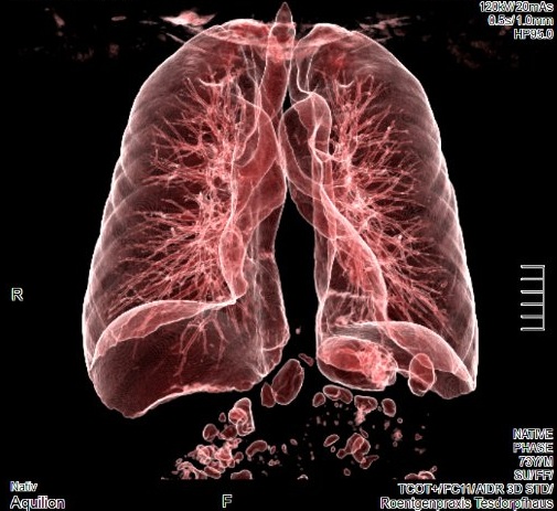 CT Lunge | Röntgenpraxis im Tesdorpfhaus