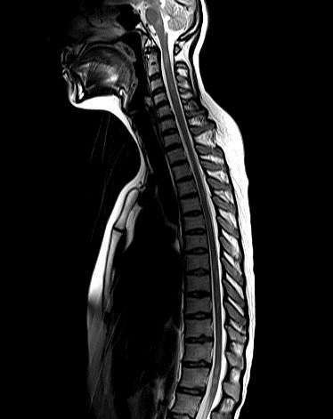 MRT Rückenmark | Röntgenpraxis im Tesdorpfhaus